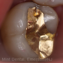 After photo of a Gold dental Onlay