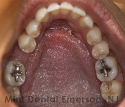 Dental Bridge as an option for missing teeth